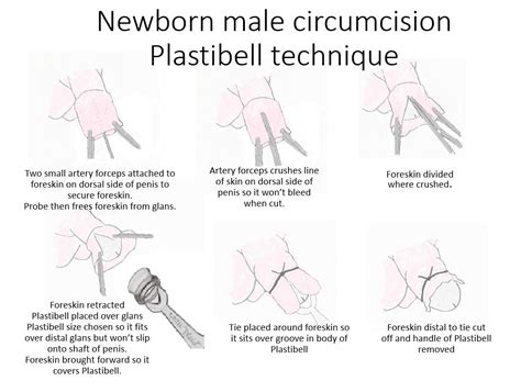 Male Circumcision Procedure