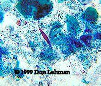 The term originally described pointed crystals in the sputum of. UA/ BF comps Flashcards - Cram.com