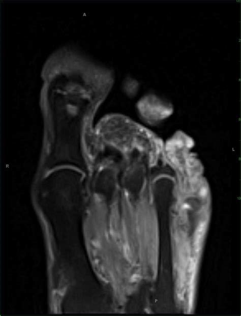 Squamous Cell Carcinoma 5th Digit Foot Musculoskeletal