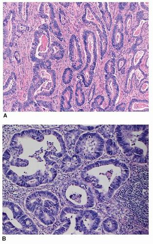 Gastric Carcinoma Classifications And Morphologic Variants Oncohema Key