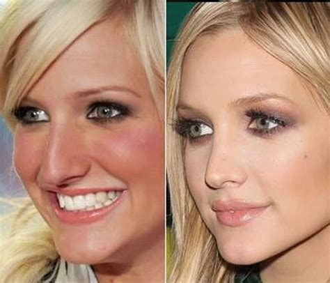 Celebrity Nose Jobs Before And After