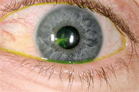 Corneal Ulcer What Is A Corneal Ulcer