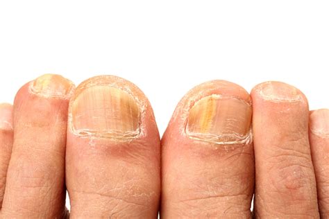 Athletes Foot Fungal Nail Infection Procare Podiatric Medicine