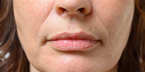 What To Do About Lip Lines Skinbetter Science®