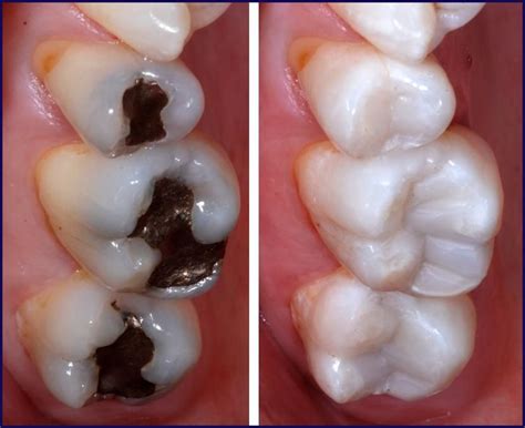 Direct Restorations Posterior Composite Three Techniques For