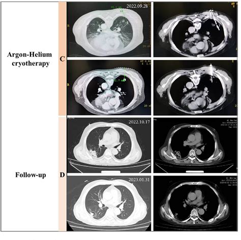Figure 2 From Pulmonary Cryptococcosis Closely Mimicking Lung Cancer In