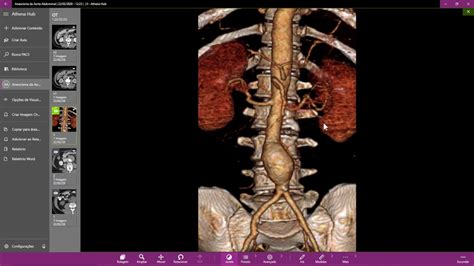 Aneurisma Da Aorta Abdominal Youtube