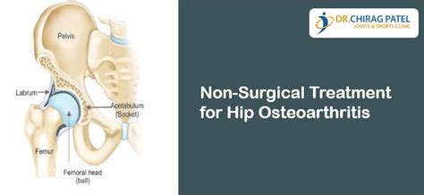 Non Surgical Treatment For Hip Osteoarthritis Dr Chirag