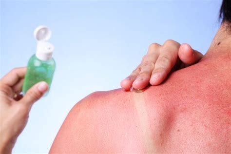 what is the best sunburn relief treatment u s dermatology partners