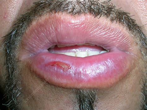 Actinic Cheilitis Stock Image C0567897 Science Photo Library