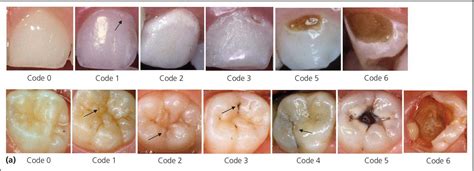 Dental Caries Gv Black Classification Of Carious Lesi