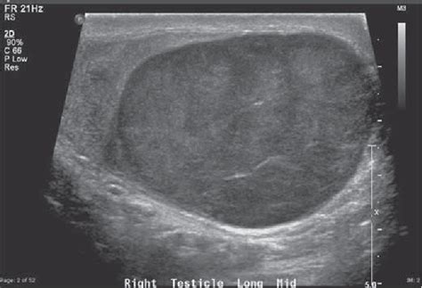 Testicular Tumor Ultrasound Characteristics And Association With