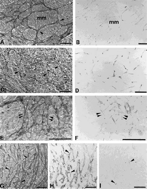 Clusters Of Malignant Melanoma Cells Mm Separated By A Network Of