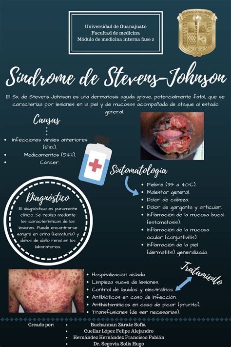 Síndrome De Steven Johnson Medicina Interna Fase 2