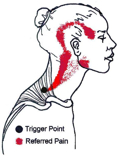 Temple Headaches Can Be Caused By Trap Tightness And Trigger Points