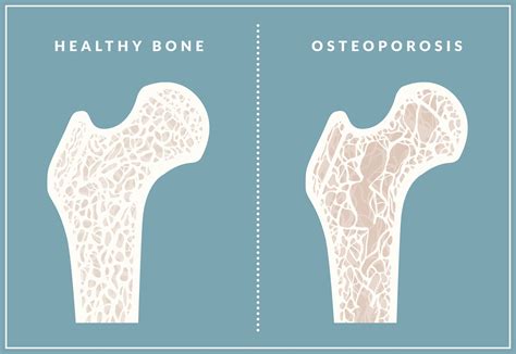 Learn Causes And Treatment Of Osteoporosis Post Pear