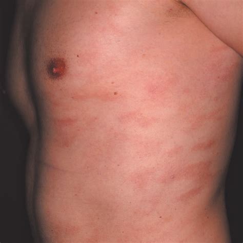 Pityriasis Rosea Salmon Colored Oval Macules With Collarette Like