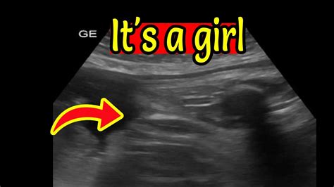 Ultrasound Showing Baby Girl Youtube