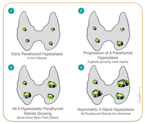 Parathyroid Hyperplasia Growth Hyperparathyroidism Surgery Dr