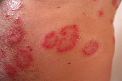 Enflamed Skin Rash It May Be Eczema Or Dermatitis Dr Robert Paull