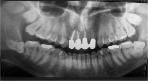 One Year Postoperative Radiograph Download Scientific Diagram