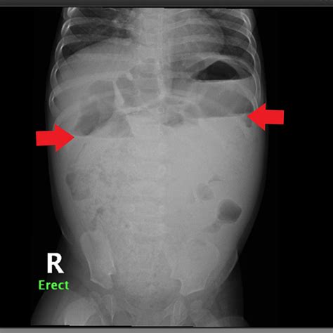Cureus Complete Currarino Triad Presenting With Chronic Constipation