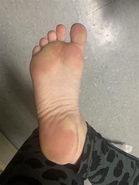 the past week the bottom my foot has been getting white like this after standing on them the