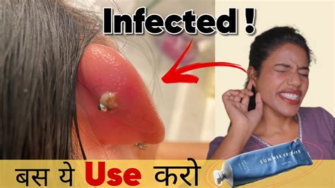 How To Heal Infected Ear Piercing Faster 100 Result Ravinaa Gupta Youtube