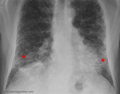 Rit Radiology Usual Interstitial Pneumonitis Uip Pattern
