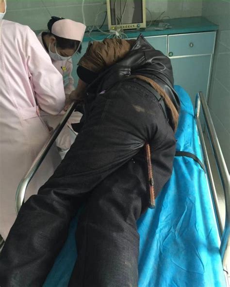 Chinese Worker Miraculously Survives Being Impaled By Rusty Steel Bar