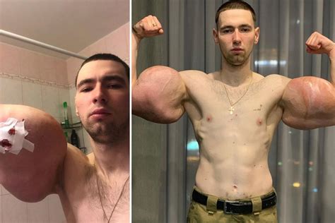 Russian Bodybuilder With 24 Inch Oil Injected Popeye Biceps Has Surgery