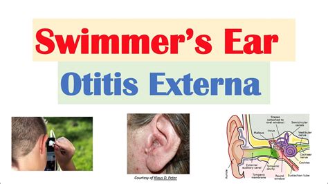 Otitis Externa Behandlung Management Hilfe Bei Psoriasis