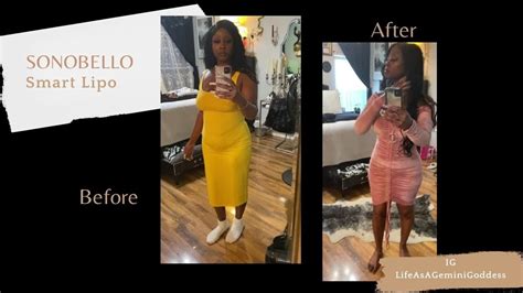 Sono Bello Before And After The Smart Lipo Journey Youtube