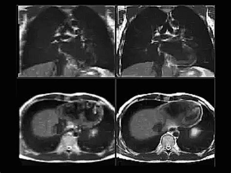 New ‘super Resolution Mri Could Help Plan Radiotherapy Treatment For