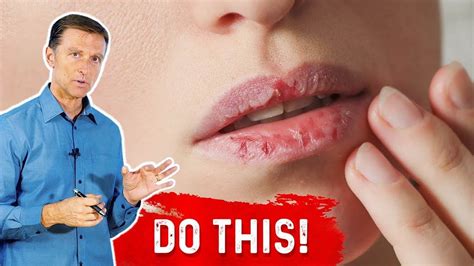 In This Video I Explain How To Fix Your Chapped Lips Chapped Lips Perfect Lips Doctor Of