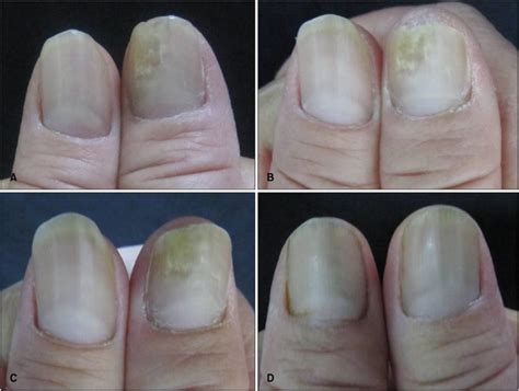 Photographs Obtained Before And After Treatment The Treated Nail Was