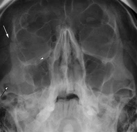 Medicinezygomaticomaxillary Complex Fracture Handwiki