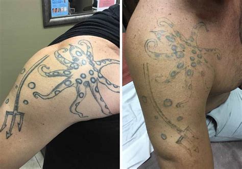 Tattoo Removal Progress Picture After Just Three Sessions