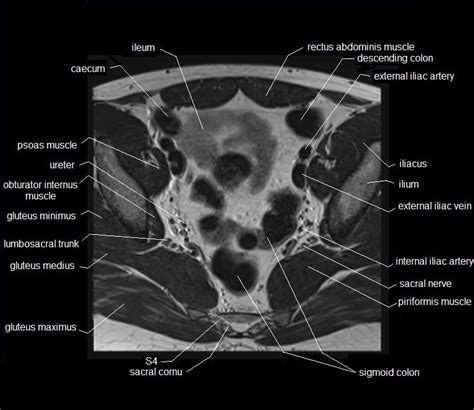 Included within the chart are gorgeous illustrations of the pelvic diaphragm, sphincter muscles, gluteus maximus. MRI pelvis anatomy | free male pelvis axial anatomy
