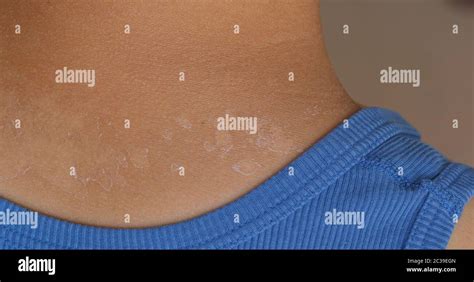 Sunburned Sunburn Peeling Skin Hi Res Stock Photography And Images Alamy