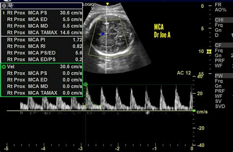 Ultrasound Imaging Normal Fetal Doppler 3rd Trimester