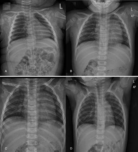 A Normal Chest X Ray Findings Before The Right Adrenalectomy B Six