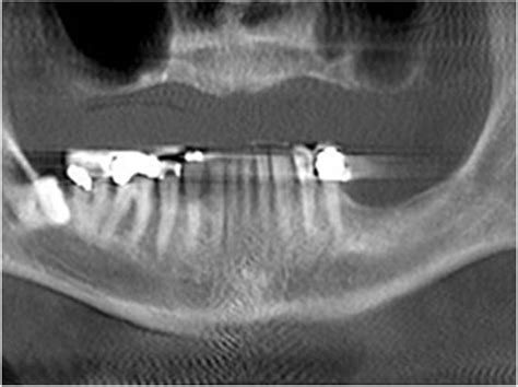 Ct Scans Overused In Patients With Dental Infections Dentistry Today