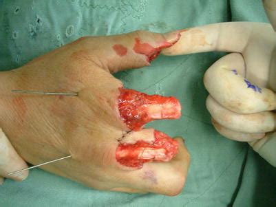 Degloving Injury | Plastic Surgery Key