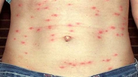 Typhus Causes Symptoms Diagnosis And Treatment Natural Health News