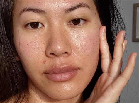 How To Get Rid Of Old Red Acne Scars