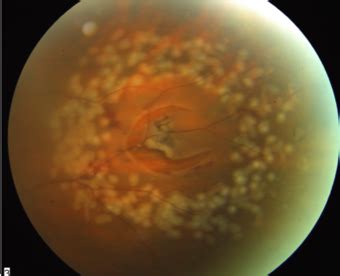 Retinal tears occur in about 2 percent of eyes at the time of a posterior vitreous detachment. Retinal Tears
