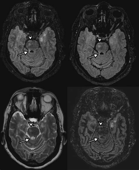 Improving Detection Of Multiple Sclerosis Lesions In The Posterior