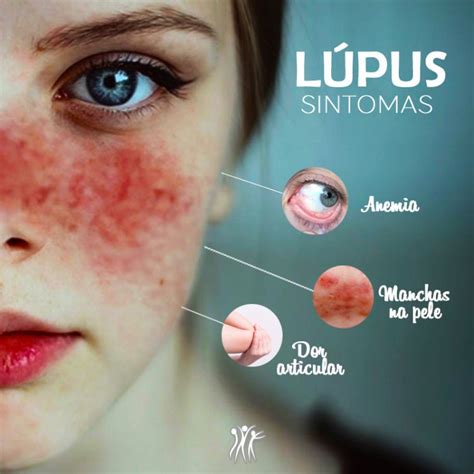 Lista 102 Foto Imágenes De Lupus En La Piel El último