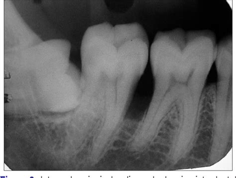 Figure From Pyogenic Granuloma Associated With Periodontal Abscess